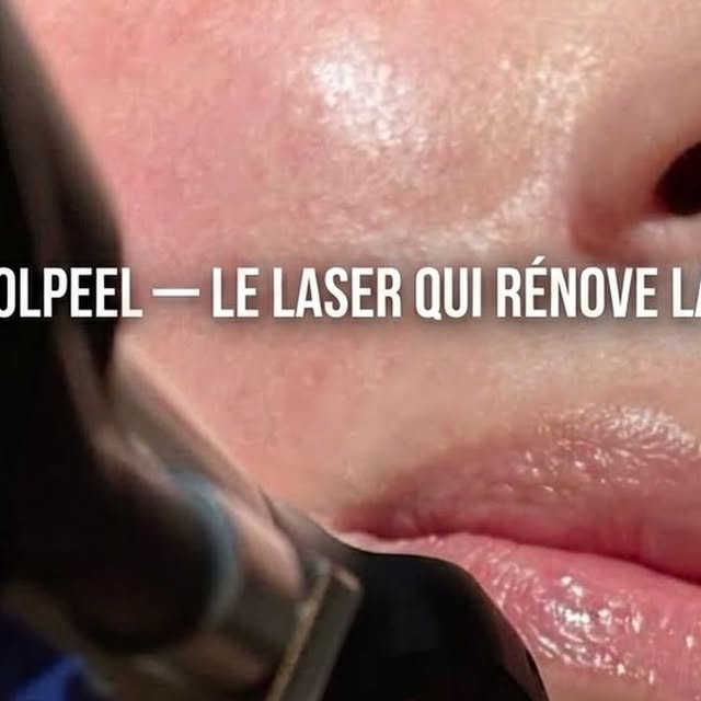 CoolPeel : le laser qui rénove la peau en douceur