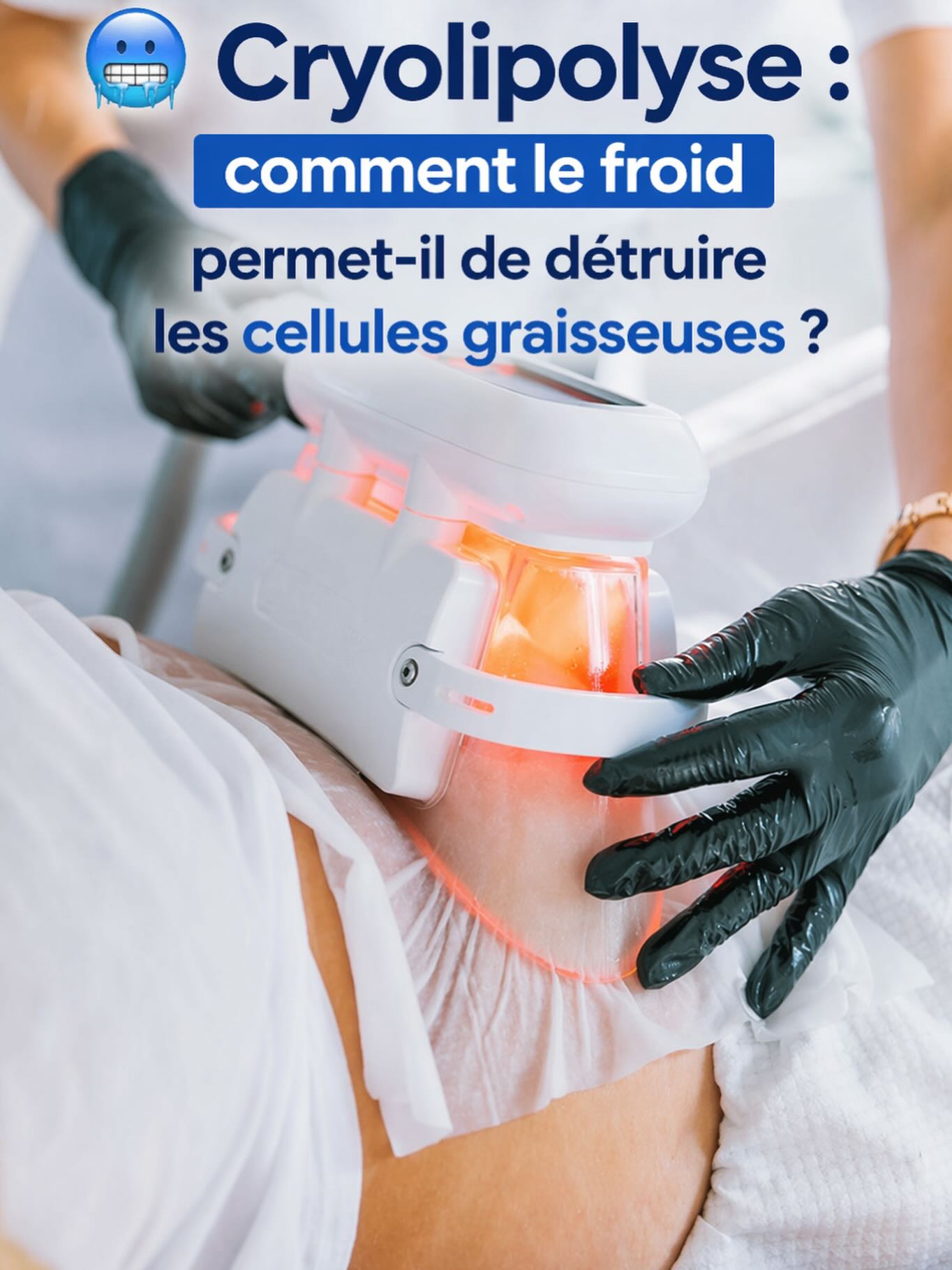 Cryolipolyse technologie référence réduction graisse silhouette corps