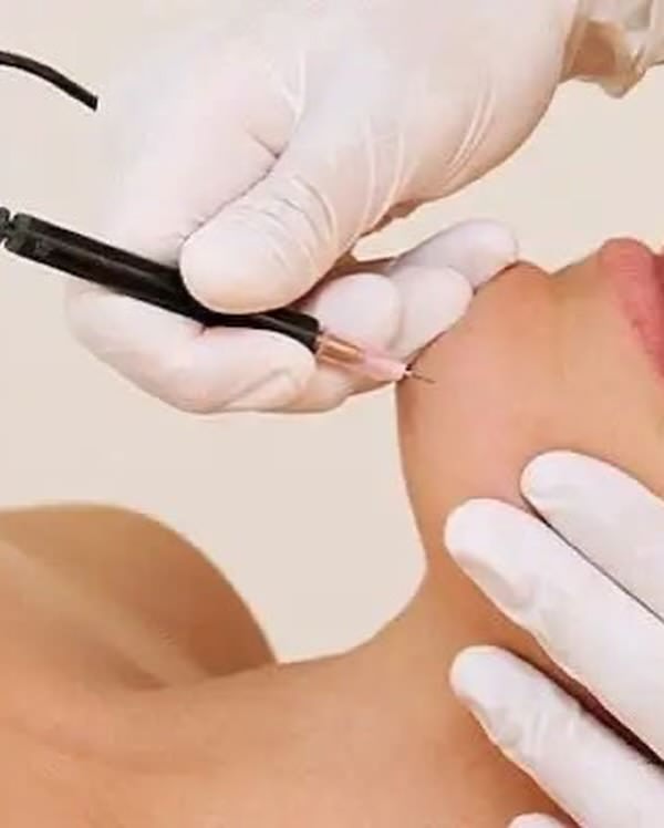 Séance d'électrolyse professionnelle sur le menton