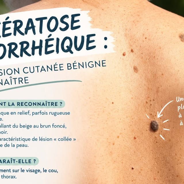 Kératose séborrhéique : lésion cutanée bénigne liée à l'âge