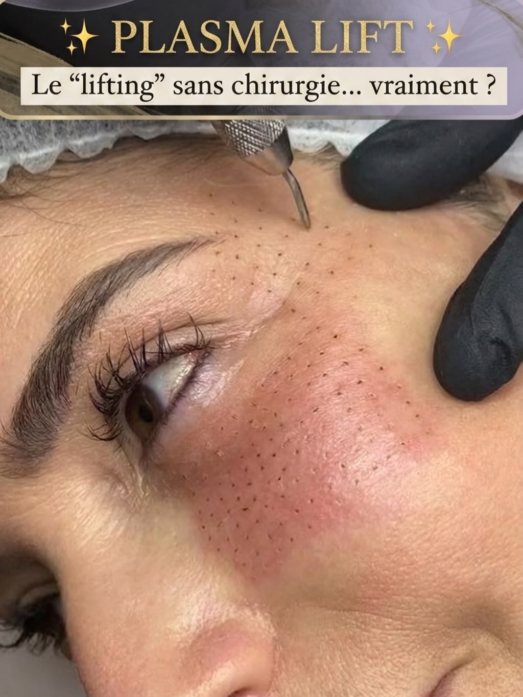 Plasma lift pen fibroblast raffermir peau rides
