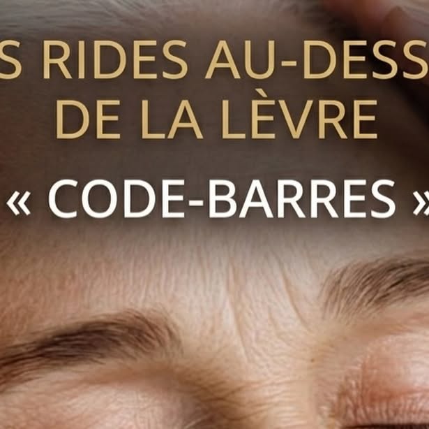 Rides péribuccales au-dessus de la lèvre