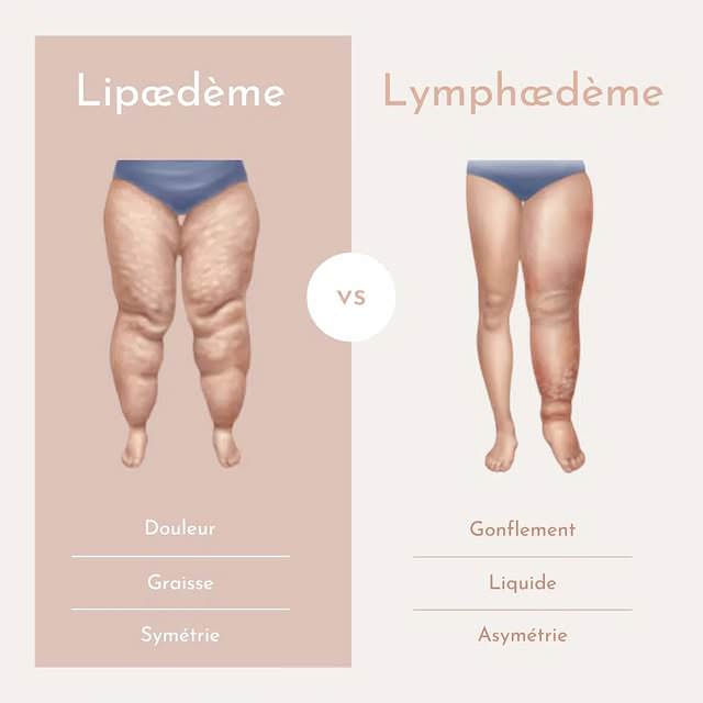 Lipoedème vs Lymphoedème